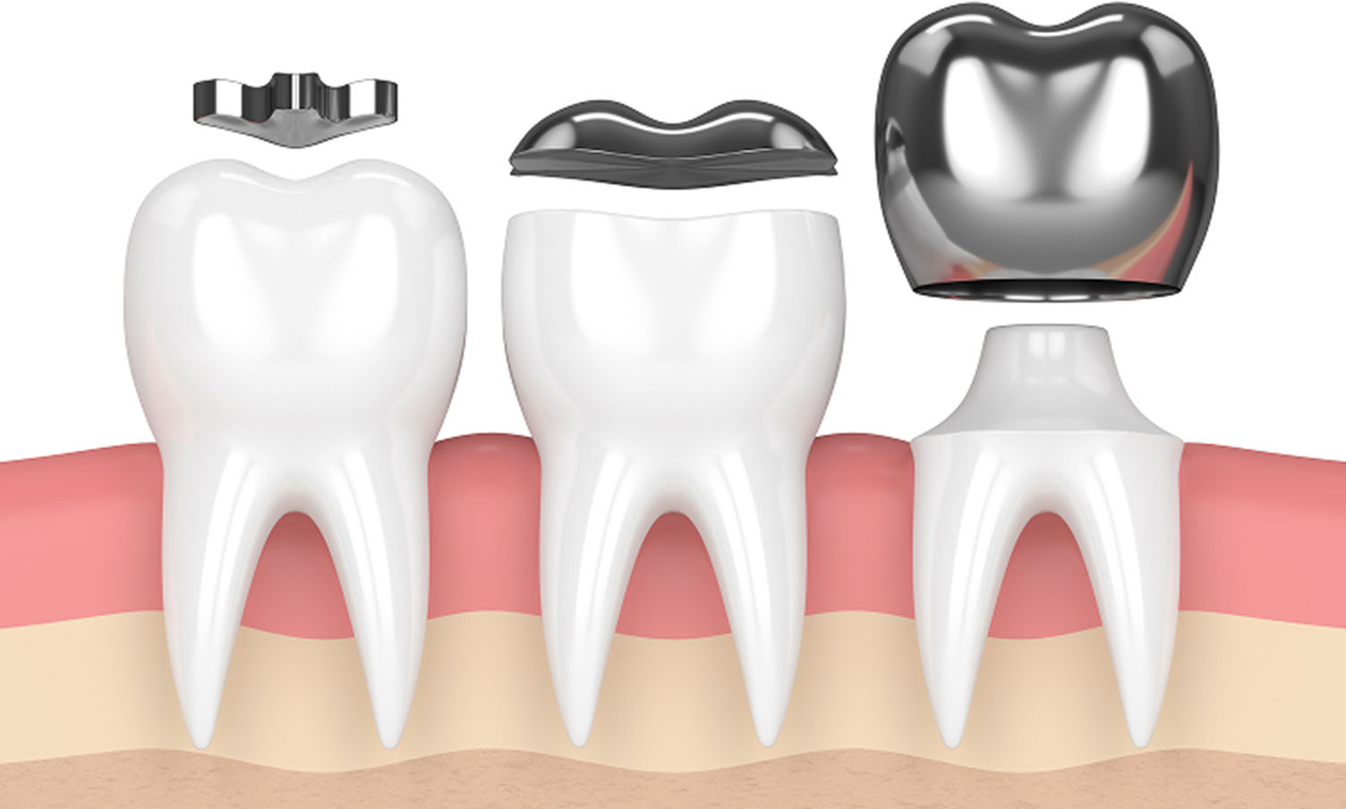 インレーとクラウンのイラスト