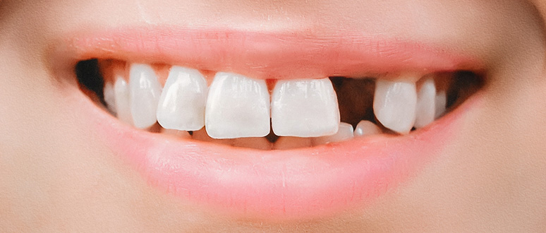 前歯が無い口元の写真