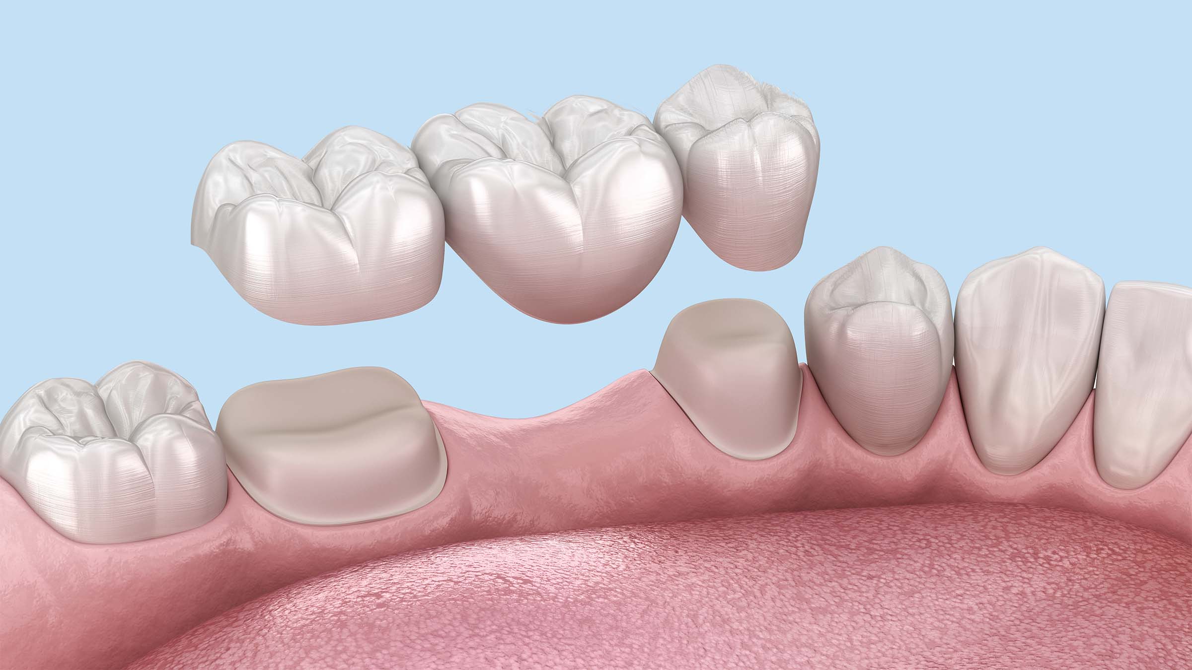 ブリッジ治療の3Dイメージ画像