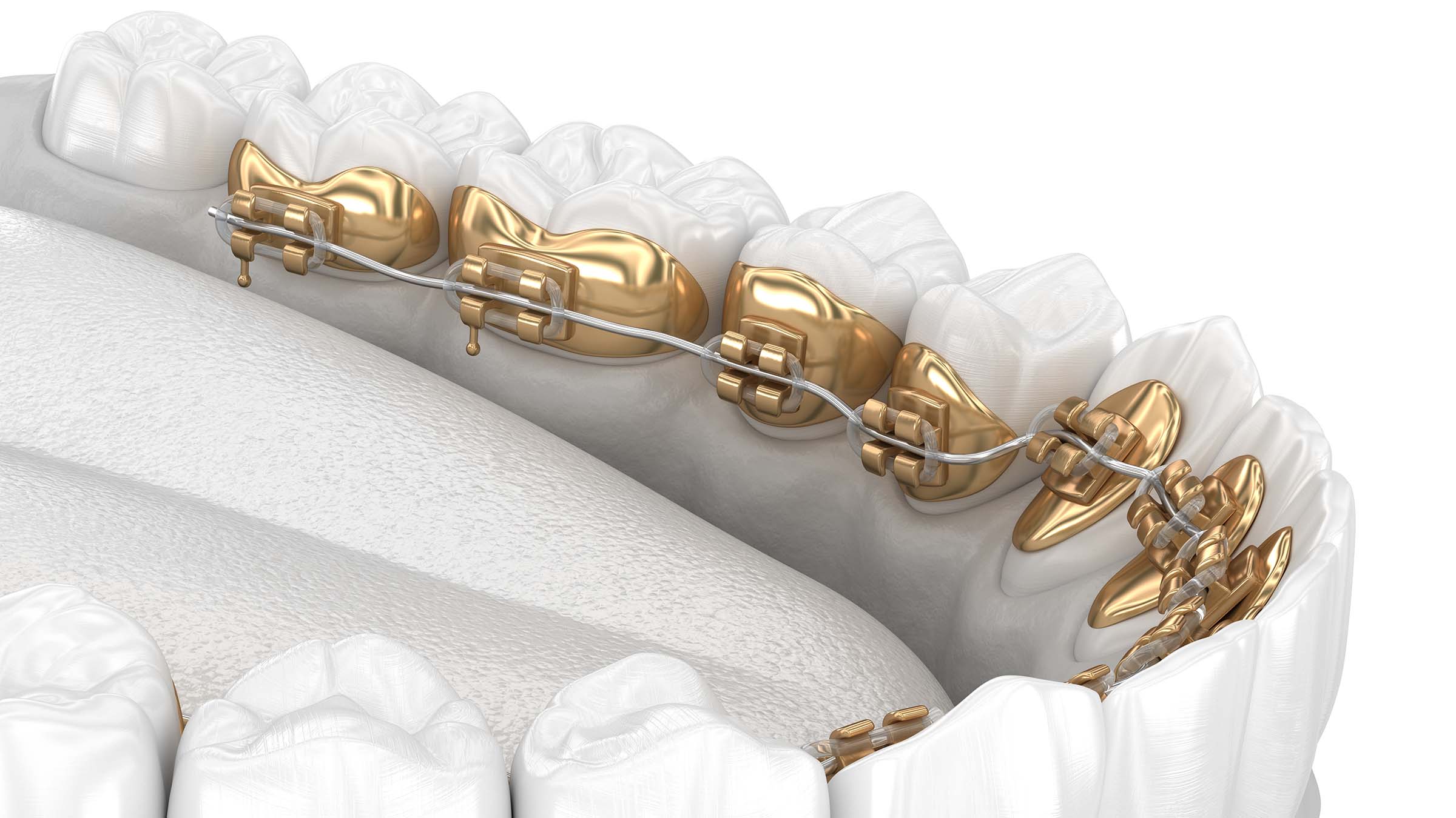 裏側矯正している女性の口元写真