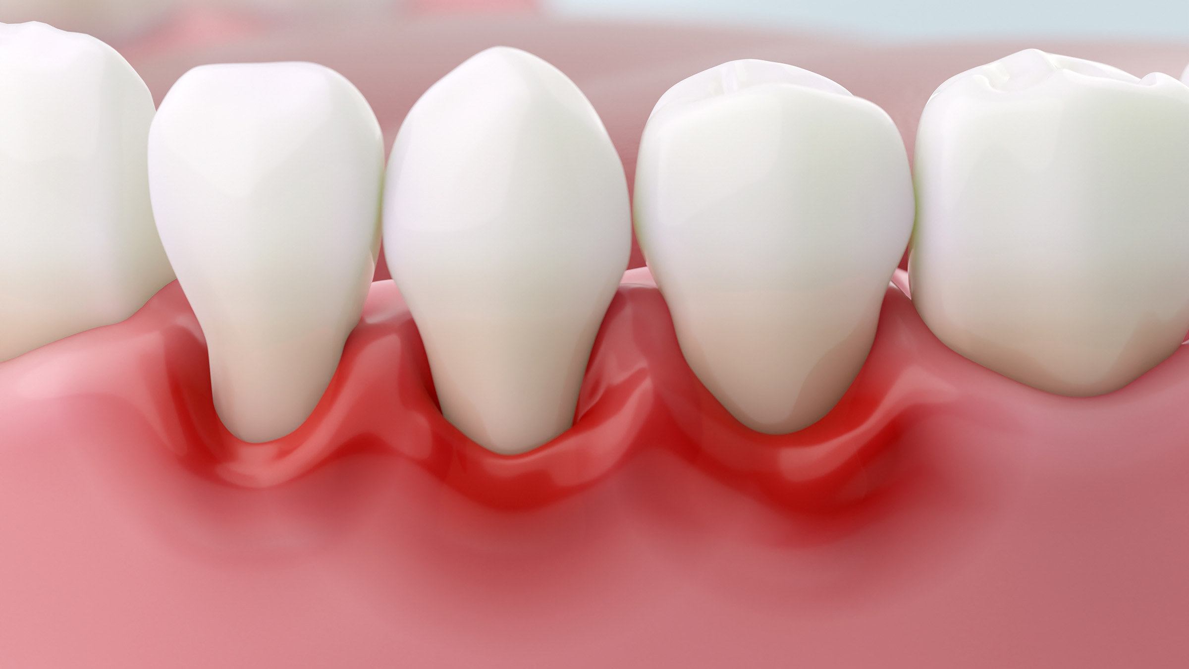 歯周病のイメージ写真
